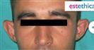 Ear Aesthetics - Estethica Surgical Medical Center