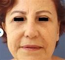 Eyelid Aesthetics (Blepharoplasty) - Estethica Surgical Medical Center