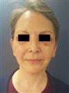 Facelift - Estethica Surgical Medical Center