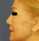 Facelift - Estethica Surgical Medical Center