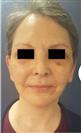 Facelift - Estethica Surgical Medical Center