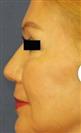 Facelift - Estethica Surgical Medical Center