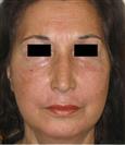 Facelift - Estethica Surgical Medical Center