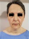Facelift - Estethica Surgical Medical Center
