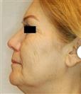 Facelift - Estethica Surgical Medical Center