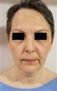 Facelift - Estethica Surgical Medical Center