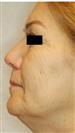 Facelift - Estethica Surgical Medical Center
