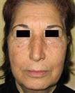 Facelift - Estethica Surgical Medical Center