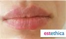 Dermal Fillers - Estethica Surgical Medical Center