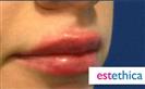 Dermal Fillers - Estethica Surgical Medical Center