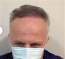Hair Transplant - Estethica Surgical Medical Center