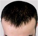 Hair Transplant - Estethica Surgical Medical Center