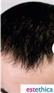 Hair Transplant - Estethica Surgical Medical Center