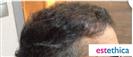 Hair Transplant - Estethica Surgical Medical Center