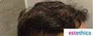 Hair Transplant - Estethica Surgical Medical Center