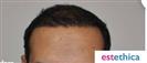 Hair Transplant - Estethica Surgical Medical Center