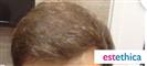 Hair Transplant - Estethica Surgical Medical Center