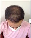 Hair Transplant - Estethica Surgical Medical Center