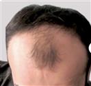 Hair Transplant - Estethica Surgical Medical Center