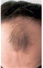 Hair Transplant - Estethica Surgical Medical Center