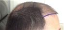 Hair Transplant - Estethica Surgical Medical Center