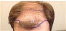 Hair Transplant - Estethica Surgical Medical Center