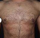 Gynecomastia - Estethica Surgical Medical Center