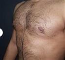 Gynecomastia - Estethica Surgical Medical Center
