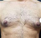 Gynecomastia - Estethica Surgical Medical Center