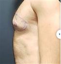 Gynecomastia - Estethica Surgical Medical Center