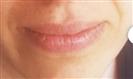 Lip Enhancement (Lip Augmentation) - Estethica Surgical Medical Center