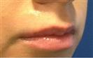 Lip Enhancement (Lip Augmentation) - Estethica Surgical Medical Center