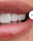 Porcelain Veneers - Estethica Surgical Medical Center