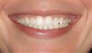 Porcelain Veneers - Estethica Surgical Medical Center