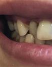 Porcelain Veneers - Estethica Surgical Medical Center