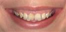 Porcelain Veneers - Estethica Surgical Medical Center