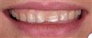 Porcelain Veneers - Estethica Surgical Medical Center