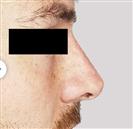 Rhinoplasty - Estethica Surgical Medical Center