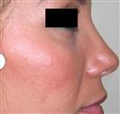 Rhinoplasty - Estethica Surgical Medical Center