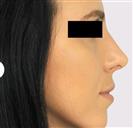 Rhinoplasty - Estethica Surgical Medical Center