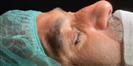 Rhinoplasty - Estethica Surgical Medical Center