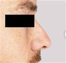 Rhinoplasty - Estethica Surgical Medical Center