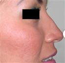 Rhinoplasty - Estethica Surgical Medical Center