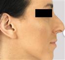 Rhinoplasty - Estethica Surgical Medical Center