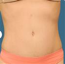 Tummy Tuck (Abdominoplasty) - Estethica Surgical Medical Center