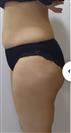 Abdominoplasty (Tummy Tuck) - Estethica Surgical Medical Center