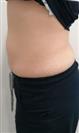Abdominoplasty (Tummy Tuck) - Estethica Surgical Medical Center