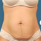 Tummy Tuck (Abdominoplasty) - Estethica Surgical Medical Center