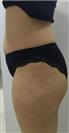 Abdominoplasty (Tummy Tuck) - Estethica Surgical Medical Center