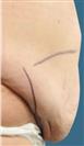 Tummy Tuck (Abdominoplasty) - Estethica Surgical Medical Center
